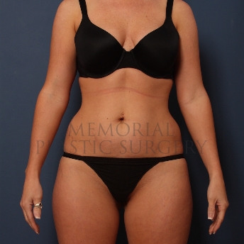 A front view before photo of patient 379 that underwent Liposuction procedures at Memorial Plastic Surgery
