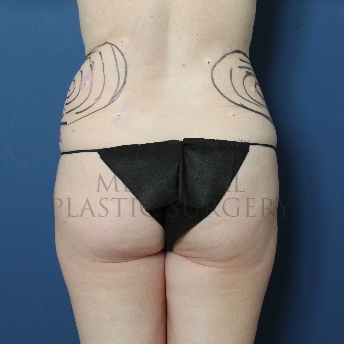 A front view before photo of patient 276 that underwent Liposuction procedures at Memorial Plastic Surgery