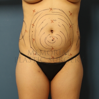 A front view before photo of patient 316 that underwent Liposuction procedures at Memorial Plastic Surgery