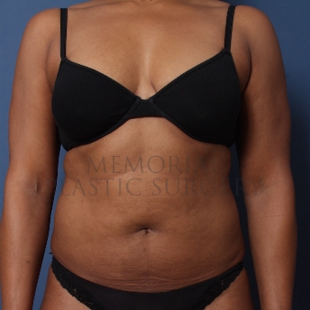 A front view before photo of patient 351 that underwent Liposuction procedures at Memorial Plastic Surgery