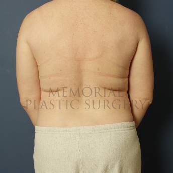 A front view before photo of patient 373 that underwent Liposuction procedures at Memorial Plastic Surgery