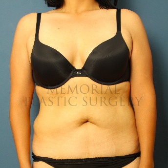 A front view before photo of patient 341 that underwent Liposuction procedures at Memorial Plastic Surgery