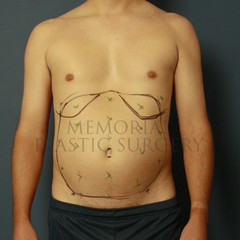 A front view before photo of patient 388 that underwent Liposuction procedures at Memorial Plastic Surgery