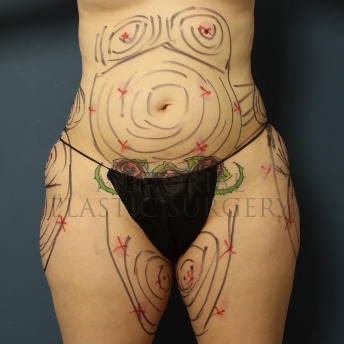 A front view before photo of patient 309 that underwent Liposuction procedures at Memorial Plastic Surgery