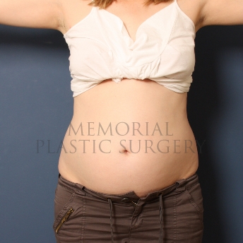 A front view before photo of patient 301 that underwent Liposuction procedures at Memorial Plastic Surgery