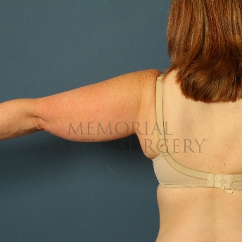 A front view before photo of patient 356 that underwent Liposuction procedures at Memorial Plastic Surgery