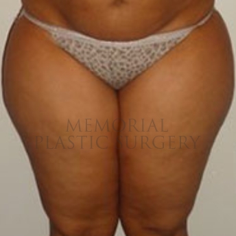 A front view before photo of patient 174 that underwent Liposuction procedures at Memorial Plastic Surgery