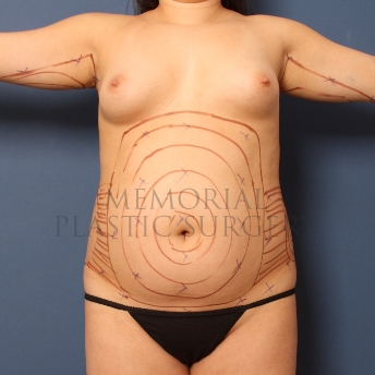A front view before photo of patient 318 that underwent Liposuction procedures at Memorial Plastic Surgery
