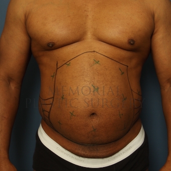 A front view before photo of patient 345 that underwent Liposuction procedures at Memorial Plastic Surgery