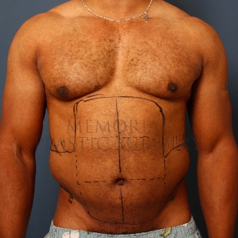 A front view before photo of patient 337 that underwent Liposuction procedures at Memorial Plastic Surgery
