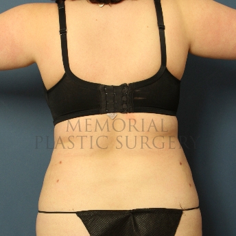 A oblique view after photo of patient 306 that underwent Liposuction procedures at Memorial Plastic Surgery