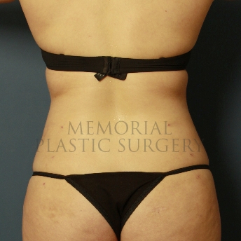 A oblique view after photo of patient 386 that underwent Liposuction procedures at Memorial Plastic Surgery