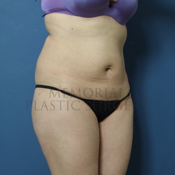 A oblique view after photo of patient 334 that underwent Liposuction procedures at Memorial Plastic Surgery