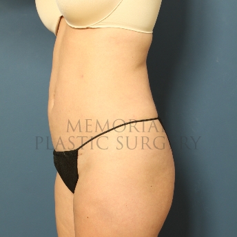A oblique view after photo of patient 305 that underwent Liposuction procedures at Memorial Plastic Surgery