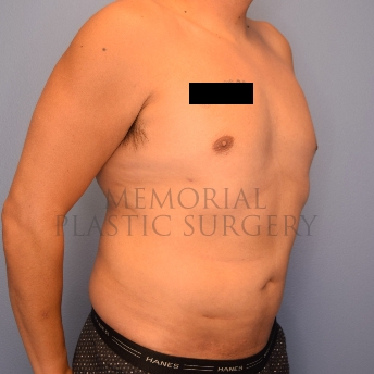 A oblique view after photo of patient 2221 that underwent Liposuction procedures at Memorial Plastic Surgery