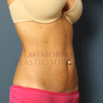 A oblique view after photo of patient 353 that underwent Liposuction procedures at Memorial Plastic Surgery