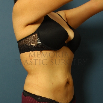 A oblique view after photo of patient 341 that underwent Liposuction procedures at Memorial Plastic Surgery