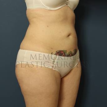 A oblique view after photo of patient 309 that underwent Liposuction procedures at Memorial Plastic Surgery