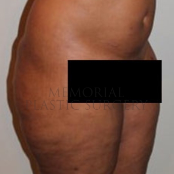 A oblique view after photo of patient 174 that underwent Liposuction procedures at Memorial Plastic Surgery