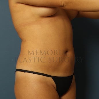A oblique view after photo of patient 318 that underwent Liposuction procedures at Memorial Plastic Surgery