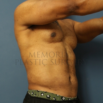 A oblique view after photo of patient 337 that underwent Liposuction procedures at Memorial Plastic Surgery