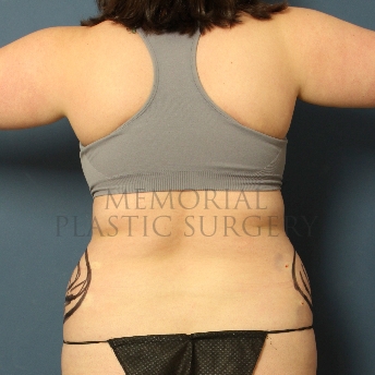 A oblique view before photo of patient 306 that underwent Liposuction procedures at Memorial Plastic Surgery