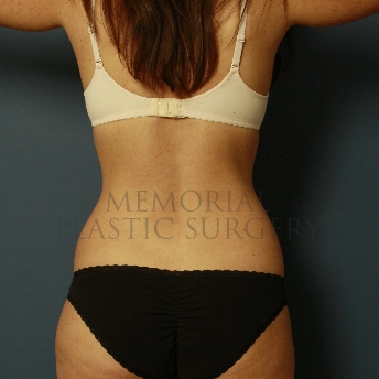 A oblique view before photo of patient 360 that underwent Liposuction procedures at Memorial Plastic Surgery