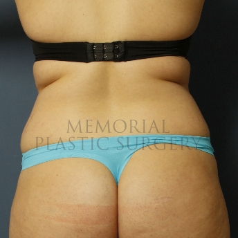 A oblique view before photo of patient 386 that underwent Liposuction procedures at Memorial Plastic Surgery