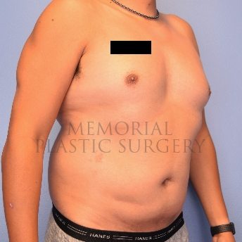 A oblique view before photo of patient 2221 that underwent Liposuction procedures at Memorial Plastic Surgery