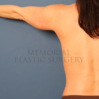 A oblique view before photo of patient 384 that underwent Liposuction procedures at Memorial Plastic Surgery