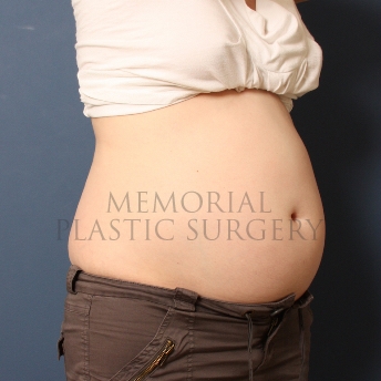 A oblique view before photo of patient 301 that underwent Liposuction procedures at Memorial Plastic Surgery