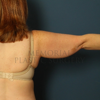 A oblique view before photo of patient 356 that underwent Liposuction procedures at Memorial Plastic Surgery