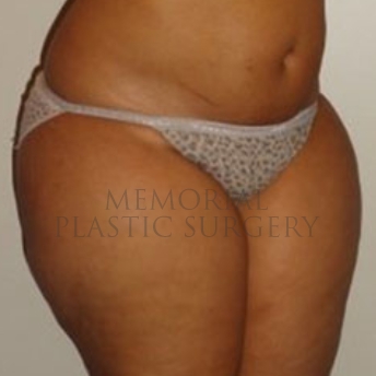 A oblique view before photo of patient 174 that underwent Liposuction procedures at Memorial Plastic Surgery