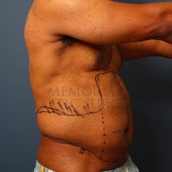 A oblique view before photo of patient 337 that underwent Liposuction procedures at Memorial Plastic Surgery