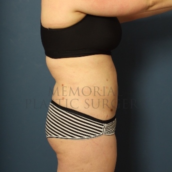 A side view after photo of patient 306 that underwent Liposuction procedures at Memorial Plastic Surgery