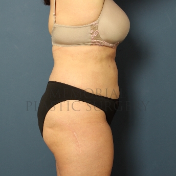 A side view after photo of patient 387 that underwent Liposuction procedures at Memorial Plastic Surgery