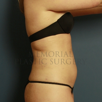 A side view after photo of patient 386 that underwent Liposuction procedures at Memorial Plastic Surgery