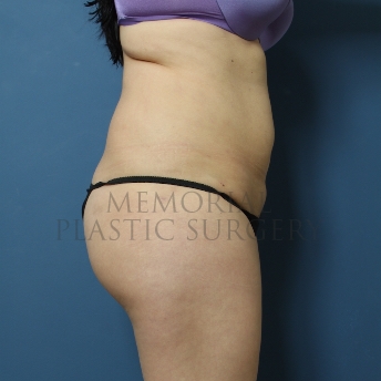 A side view after photo of patient 334 that underwent Liposuction procedures at Memorial Plastic Surgery