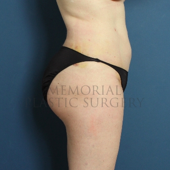 A side view after photo of patient 276 that underwent Liposuction procedures at Memorial Plastic Surgery