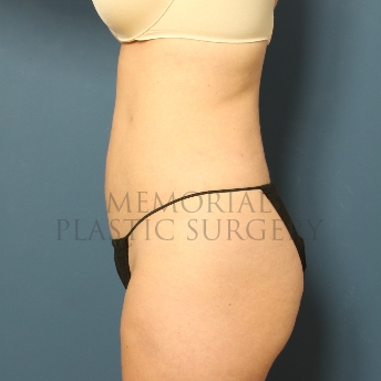 A side view after photo of patient 305 that underwent Liposuction procedures at Memorial Plastic Surgery