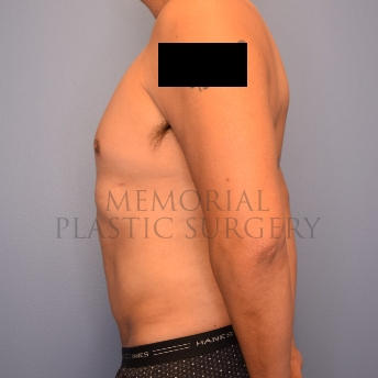 A side view after photo of patient 2221 that underwent Liposuction procedures at Memorial Plastic Surgery