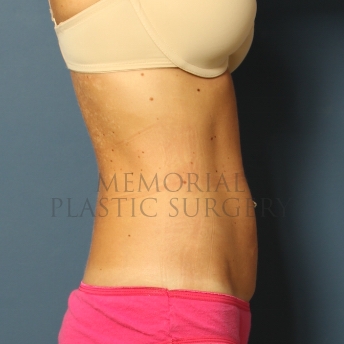 A side view after photo of patient 353 that underwent Liposuction procedures at Memorial Plastic Surgery