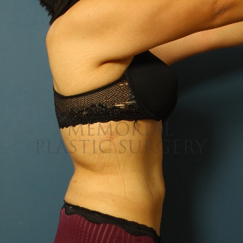 A side view after photo of patient 341 that underwent Liposuction procedures at Memorial Plastic Surgery