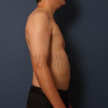 A side view after photo of patient 388 that underwent Liposuction procedures at Memorial Plastic Surgery