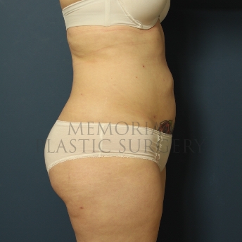 A side view after photo of patient 309 that underwent Liposuction procedures at Memorial Plastic Surgery