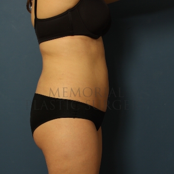 A side view after photo of patient 375 that underwent Liposuction procedures at Memorial Plastic Surgery