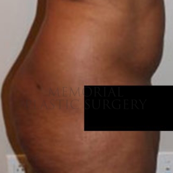 A side view after photo of patient 174 that underwent Liposuction procedures at Memorial Plastic Surgery