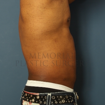 A side view after photo of patient 345 that underwent Liposuction procedures at Memorial Plastic Surgery