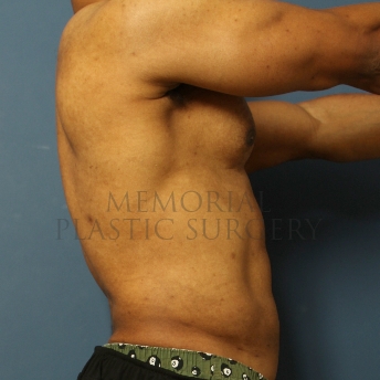 A side view after photo of patient 337 that underwent Liposuction procedures at Memorial Plastic Surgery