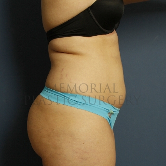 A side view before photo of patient 386 that underwent Liposuction procedures at Memorial Plastic Surgery